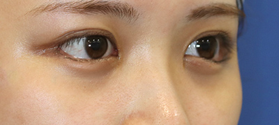 新宿ラクル美容外科クリニック　山本厚志　目頭切開＋下眼瞼下制術（たれ目術）　手術後３ヶ月目　９月１７日
