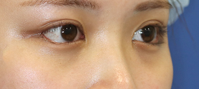 新宿ラクル美容外科クリニック　山本厚志　目頭切開＋下眼瞼下制術（たれ目術）　手術後６ヶ月目　９月１７日
