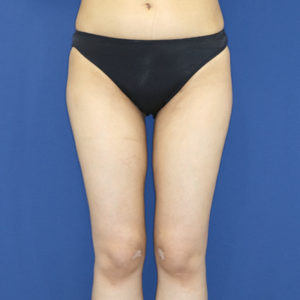 新宿ラクル美容外科クリニック　山本厚志　「ライポライフ脂肪吸引（お尻＋太もも全体＋ひざ周り）」　手術後６ヶ月目　９月３日
