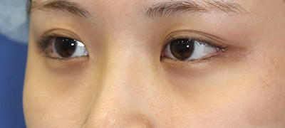 新宿ラクル美容外科クリニック　山本厚志　目頭切開＋下眼瞼下制術（たれ目術）　手術前　９月１７日