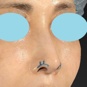 「鼻孔縁下降術」　新宿ラクル美容外科クリニック　５０代女性　デザイン　９月２７日