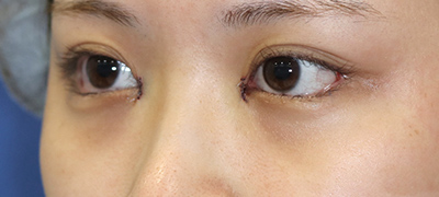 新宿ラクル美容外科クリニック　山本厚志　目頭切開＋下眼瞼下制術（たれ目術）　手術直後　９月１７日