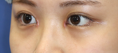 新宿ラクル美容外科クリニック　山本厚志　目頭切開＋下眼瞼下制術（たれ目術）　手術後１週間目　９月１７日