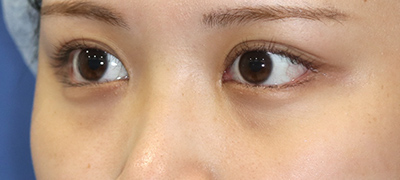 新宿ラクル美容外科クリニック　山本厚志　目頭切開＋下眼瞼下制術（たれ目術）　手術後１２ヶ月目　９月１７日