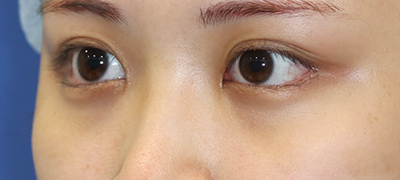 新宿ラクル美容外科クリニック　山本厚志　目頭切開＋下眼瞼下制術（たれ目術）　手術後２ヶ月目　９月１７日