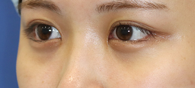 新宿ラクル美容外科クリニック　山本厚志　目頭切開＋下眼瞼下制術（たれ目術）　手術後３ヶ月目　９月１７日