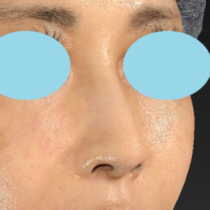 「鼻孔縁下降術」　新宿ラクル美容外科クリニック　５０代女性　手術後３ヶ月目　１１月３日