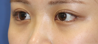 新宿ラクル美容外科クリニック　山本厚志　目頭切開＋下眼瞼下制術（たれ目術）　手術後６ヶ月目　９月１７日