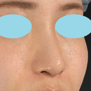 新宿ラクル美容外科クリニック　山本厚志　「小鼻縮小+α法」　手術後６ヶ月目　１０月１日