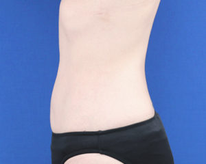 新宿ラクル美容外科クリニック　山本厚志　「ライポライフ脂肪吸引（腹部全体＋腰）」　手術後１２ヶ月目　４月７日