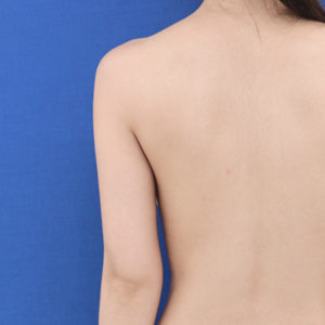 新宿ラクル美容外科クリニック　山本厚志　「ライポライフ脂肪吸引（二の腕+背中上部）」　手術前　９月４日