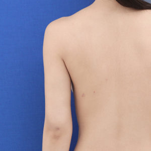 新宿ラクル美容外科クリニック　山本厚志　「ライポライフ脂肪吸引（二の腕+背中上部）」　手術後１ヶ月目　９月４日