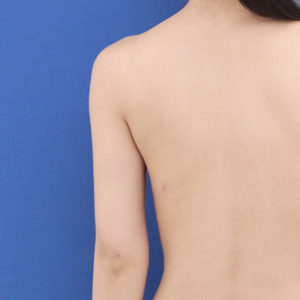 新宿ラクル美容外科クリニック　山本厚志　「ライポライフ脂肪吸引（二の腕+背中上部）」　手術後３ヶ月目　９月２２日