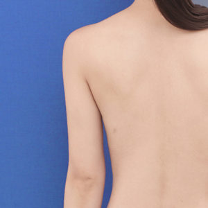 新宿ラクル美容外科クリニック　山本厚志　「ライポライフ脂肪吸引（二の腕+背中上部）」　手術後６ヶ月目　１０月２２日