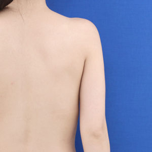 新宿ラクル美容外科クリニック　山本厚志　「ライポライフ脂肪吸引（二の腕+背中上部）」　手術前　９月４日