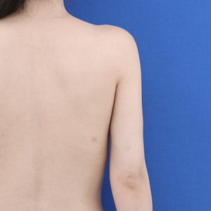 新宿ラクル美容外科クリニック　山本厚志　「ライポライフ脂肪吸引（二の腕+背中上部）」　手術後２ヶ月目　９月４日