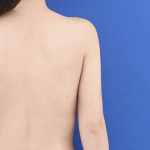 新宿ラクル美容外科クリニック　山本厚志　「ライポライフ脂肪吸引（二の腕+背中上部）」　手術後６ヶ月目　１０月２２日