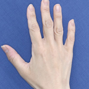 新宿ラクル美容外科クリニック　山本厚志　「手の若返り（プレミアムPRP×FGF皮膚再生療法）」　治療後１２ヶ月目　５月２９日