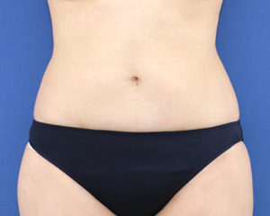 新宿ラクル美容外科クリニック　山本厚志　「ライポライフ脂肪吸引（腹部全体＋腰）」　手術後６ヶ月目　１月２１日