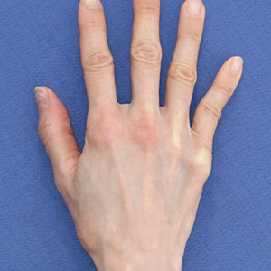 新宿ラクル美容外科クリニック　山本厚志　「手の若返り（プレミアムPRP×FGF皮膚再生療法）」　治療後６ヶ月目　１月１７日