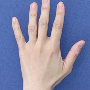 新宿ラクル美容外科クリニック　山本厚志　「手の若返り（プレミアムPRP×FGF皮膚再生療法）」　治療後１２ヶ月目　５月２９日