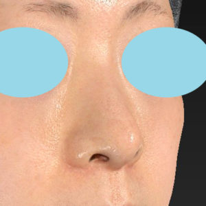 「小鼻縮小+α＋鼻尖縮小（close法）」　新宿ラクル美容外科クリニック　４０代女性　手術後１２ヶ月目　４月４日