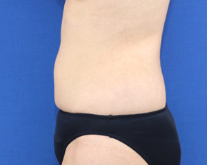 新宿ラクル美容外科クリニック　山本厚志　「ライポライフ脂肪吸引（腹部全体＋腰）」　手術後６ヶ月目　１月２１日