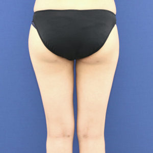 新宿ラクル美容外科クリニック　山本厚志　「ライポライフ脂肪吸引（お尻＋太もも全体＋ひざ周り）」　手術後１２ヶ月目　３月３日