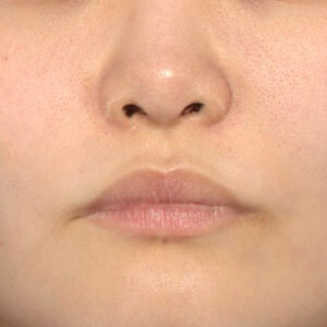 新宿ラクル美容外科クリニック　山本厚志　「貴族手術（鼻翼基部プロテーゼ）」　手術後６ヶ月目　１０月５日