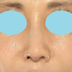 「鼻孔縁下降術」　新宿ラクル美容外科クリニック　５０代女性　手術後６ヶ月目　１月１８日
