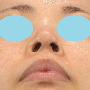 「鼻孔縁下降術」　新宿ラクル美容外科クリニック　３０代女性　手術後１２ヶ月目　４月２４日