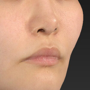 新宿ラクル美容外科クリニック　山本厚志　「貴族手術（鼻翼基部プロテーゼ）」　手術後６ヶ月目　１０月５日