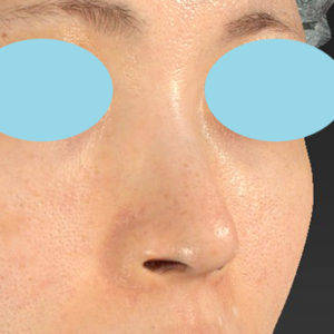 「鼻孔縁下降術」　新宿ラクル美容外科クリニック　３０代女性　手術後１２ヶ月目　４月２４日
