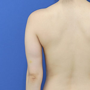 新宿ラクル美容外科クリニック　山本厚志　「ライポライフ脂肪吸引（二の腕+背中上部）」　手術前　１１月８日