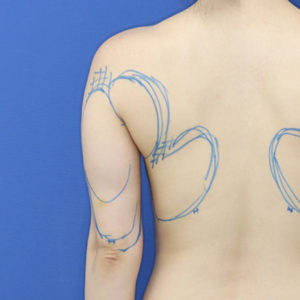 新宿ラクル美容外科クリニック　山本厚志　「ライポライフ脂肪吸引（二の腕+背中上部）」　デザイン　１１月８日