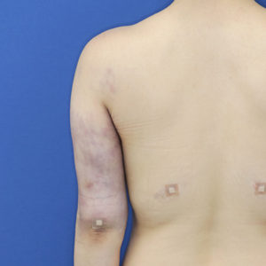 新宿ラクル美容外科クリニック　山本厚志　「ライポライフ脂肪吸引（二の腕+背中上部）」　手術直後　１１月８日
