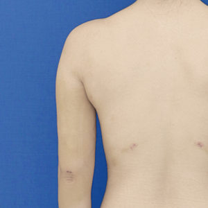 新宿ラクル美容外科クリニック　山本厚志　「ライポライフ脂肪吸引（二の腕+背中上部）」　手術後１週間目　１１月８日