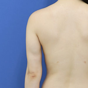 新宿ラクル美容外科クリニック　山本厚志　「ライポライフ脂肪吸引（二の腕+背中上部）」　手術後１２ヶ月目　１２月３１日