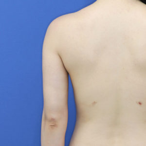 新宿ラクル美容外科クリニック　山本厚志　「ライポライフ脂肪吸引（二の腕+背中上部）」　手術後１ヶ月目　１１月８日