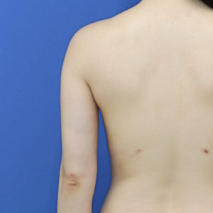 新宿ラクル美容外科クリニック　山本厚志　「ライポライフ脂肪吸引（二の腕+背中上部）」　手術後２ヶ月目　１１月８日