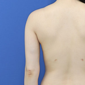 新宿ラクル美容外科クリニック　山本厚志　「ライポライフ脂肪吸引（二の腕+背中上部）」　手術後６ヶ月目　１１月８日