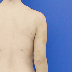 新宿ラクル美容外科クリニック　山本厚志　「ライポライフ脂肪吸引（二の腕+背中上部）」　手術後１週間目　１１月８日