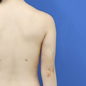 新宿ラクル美容外科クリニック　山本厚志　「ライポライフ脂肪吸引（二の腕+背中上部）」　手術後２ヶ月目　１１月８日