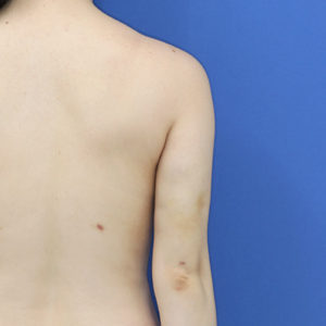 新宿ラクル美容外科クリニック　山本厚志　「ライポライフ脂肪吸引（二の腕+背中上部）」　手術後３ヶ月目　１１月８日