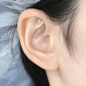 「鼻孔縁下降術（耳の傷痕）」　新宿ラクル美容外科クリニック　山本厚志　２０代女性　手術前　１２月２０日