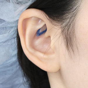 「鼻孔縁下降術（耳の傷痕）」　新宿ラクル美容外科クリニック　山本厚志　２０代女性　デザイン　１２月２０日