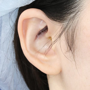 「鼻孔縁下降術（耳の傷痕）」　新宿ラクル美容外科クリニック　山本厚志　２０代女性　手術直後　１２月２０日
