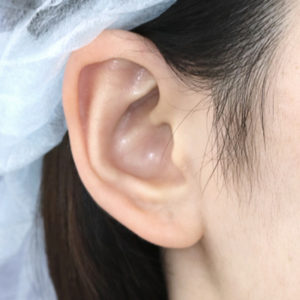 「鼻孔縁下降術（耳の傷痕）」　新宿ラクル美容外科クリニック　山本厚志　２０代女性　手術後２週間目　１２月２０日