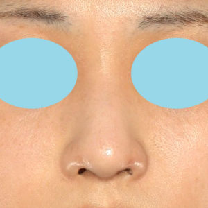 「鼻孔縁下降術」　新宿ラクル美容外科クリニック　山本厚志　２０代女性　手術後１ヶ月目　１２月１７日