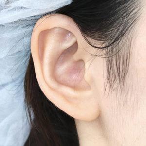 「鼻孔縁下降術（耳の傷痕）」　新宿ラクル美容外科クリニック　山本厚志　２０代女性　手術後１ヶ月目　１２月２０日